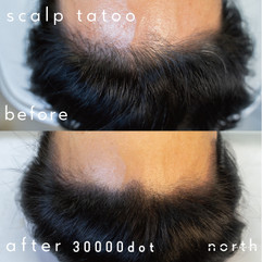 生え際 スカルプ