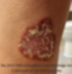 psoriasis patches