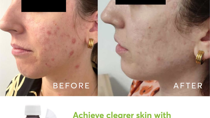 before and after acne treatment