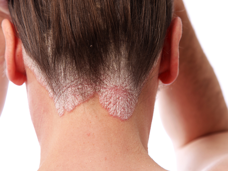 VÍNCULO ENTRE LA PSORIASIS Y EL HÍGADO GRASO