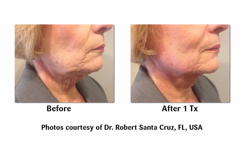 viora skin tightening near me