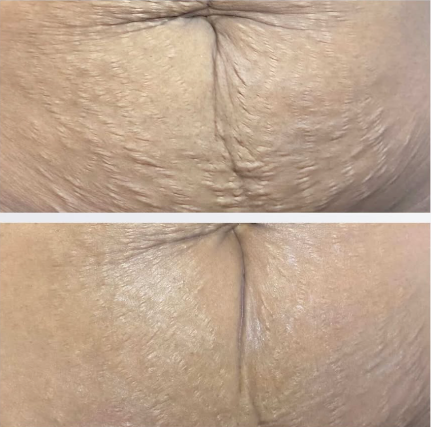Before and after PRX Plus treatment and Forma radiofrequency. Improvement in stomach tightness, stretch mark reduction, and uneven color.