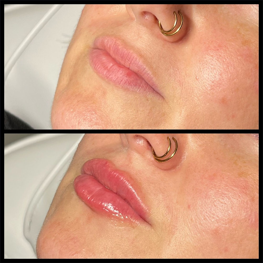 Before and after lip filler with RHA Collection, natural results.