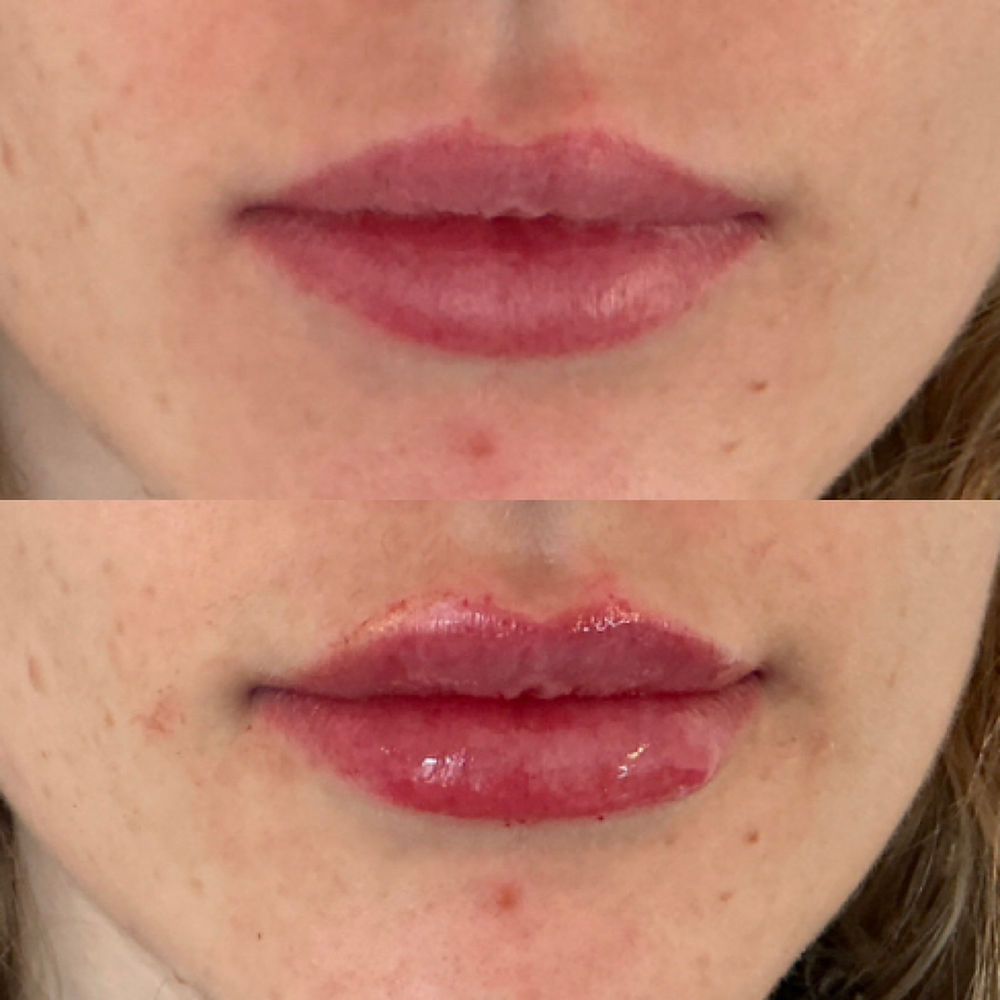 Before and after lip filler using RHA collection. Natural result.