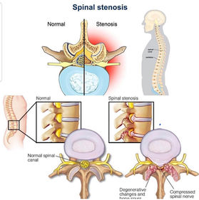 Lumbar Spinal Stenosis is a degenerative spinal condition characterized by the narrowing of the lumbar spinal canal due to a variety of bony or soft tissues structures.