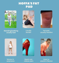 hoffa fat pad impingement /syndrome usually have pain patterns:
1) standing walking usually more painful
2) locally swollen
3) likes bending knee or positions that keep knee bend (sitting
4) likes to stand with knee in flexion
5) heels can relieve pain
6) worse in extension (standing/flat shoes/slippers)
