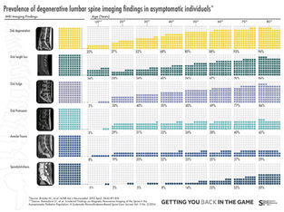 Systematic Literature Review of Imaging Features of Spinal Degeneration in Asymptomatic Populations
W. Brinjikji, P.H. Luetmer, B. Comstock, B.W. Bresnahan, L.E. Chen, R.A. Deyo, S. Halabi, J.A. Turner, A.L. Avins, K. James, J.T. Wald, D.F. Kallmes, J.G. Jarvik
American Journal of Neuroradiology Apr 2015, 36 (4) 811-816; DOI: 10.3174/ajnr.A4173
RESULTS: Thirty-three articles reporting imaging findings for 3110 asymptomatic individuals met our study inclusion criteria. The prevalence of disk degeneration in asymptomatic individuals increased from 37% of 20-year-old individuals to 96% of 80-year-old individuals. Disk bulge prevalence increased from 30% of those 20 years of age to 84% of those 80 years of age. Disk protrusion prevalence increased from 29% of those 20 years of age to 43% of those 80 years of age. The prevalence of annular fissure increased from 19% of those 20 years of age to 29% of those 80 years of age.
CONCLUSIONS: Imaging findings of spine degeneration are present in high proportions of asymptomatic individuals, increasing with age. Many imaging-based degenerative features are likely part of normal aging and unassociated with pain. These imaging findings must be interpreted in the context of the patient's clinical condition.