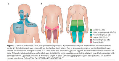 Gellhorn AC, Katz JN, Suri P. Osteoarthritis of the spine: the facet joints. Nat Rev Rheumatol. 2013 Apr;9(4):216-24. doi: 10.1038/nrrheum.2012.199. Epub 2012 Nov 13. PMID: 23147891; PMCID: PMC4012322.