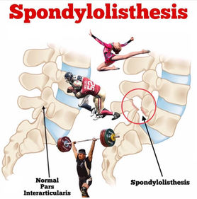spondylolisthesis is where one of the bones in your spine, known as a vertebra, slips out of position.
can be caused by:
a birth defect in part of the spine – this can cause it to slip forward
repetitive trauma to the spine – this results in a defect developing in the spine, which can cause it to slip; it's more common in athletes such as gymnasts and weightlifters
the joints of the vertebrae becoming worn and arthritic – this is more common in older people
a sudden injury or trauma to the spine – such as a fracture, which can result in the vertebra slipping forward
a bone abnormality – this can be caused by a tumour, for example
