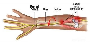 Radial+nerve+compression+image.jpeg