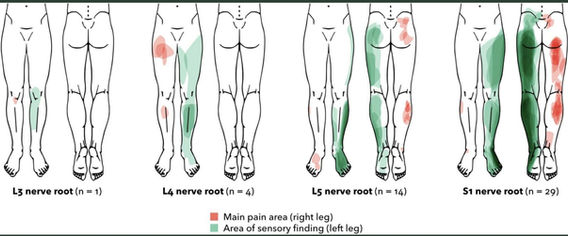 Ekedahl H, Jönsson B, Annertz M, Frobell RB. Accuracy of Clinical Tests in Detecting Disk Herniation and Nerve Root Compression in Subjects With Lumbar Radicular Symptoms. Arch Phys Med Rehabil. 2018 Apr;99(4):726-735. doi: 10.1016/j.apmr.2017.11.006. Epub 2017 Dec 15. PMID: 29253501.