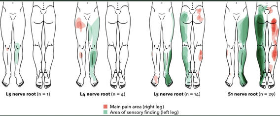 Ekedahl H, Jönsson B, Annertz M, Frobell RB. Accuracy of Clinical Tests in Detecting Disk Herniation and Nerve Root Compression in Subjects With Lumbar Radicular Symptoms. Arch Phys Med Rehabil. 2018 Apr;99(4):726-735. doi: 10.1016/j.apmr.2017.11.006. Epub 2017 Dec 15. PMID: 29253501.