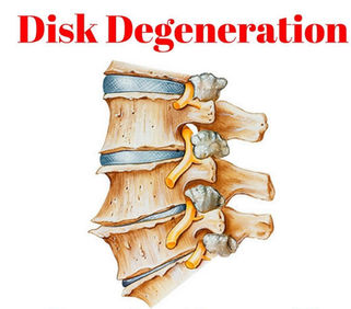 degenerative disc disease: disc desiccation, disc bulge, herniated / slipped disc