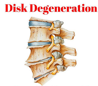 degenerative disc disease: disc desiccation, disc bulge, herniated / slipped disc
