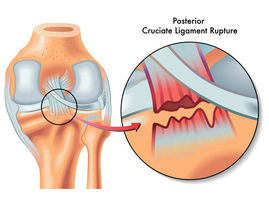 Posterior cruciate ligament (PCL) injury happens far less often than does injury to the knee's more vulnerable counterpart, the anterior cruciate ligament (ACL). The posterior cruciate ligament and ACL connect your thighbone (femur) to your shinbone (tibia). If either ligament is torn, it might cause pain, swelling and a feeling of instability.
Ligaments are strong bands of tissue that attach one bone to another. The cruciate (KROO-she-ate) ligaments connect the thighbone (femur) to the shinbone (tibia). The anterior and posterior cruciate ligaments form an "X" in the center of the knee.
Although a posterior cruciate ligament injury generally causes less pain, disability and knee instability than does an ACL tear, it can still sideline you for several weeks or months.
Symptoms
Signs and symptoms of a PCL injury can include:
Pain. Mild to moderate pain in the knee can cause a slight limp or difficulty walking.
Swelling. Knee swelling occurs rapidly, within hours of the injury.
Instability. Your knee might feel loose, as if it's going to give way.
If there are no associated injuries to other parts of your knee, the signs and symptoms of a posterior cruciate ligament injury can be so mild that you might not notice that anything's wrong. Over time, the pain might worsen and your knee might feel more unstable. If other parts of your knee have also been injured, your signs and symptoms will likely be more severe.