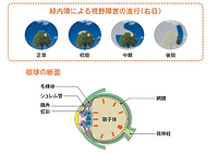 緑内障治療