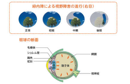 緑内障の早期発見・適切な治療を