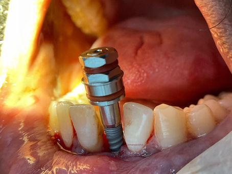 Dental Implant replacing missing tooth.