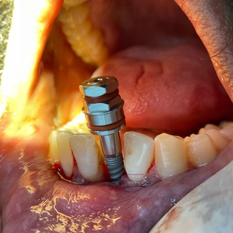 Dental Implant replacing missing tooth.