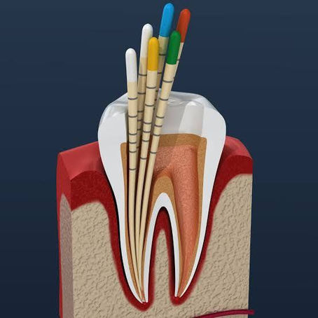 Image showing root canal treatment