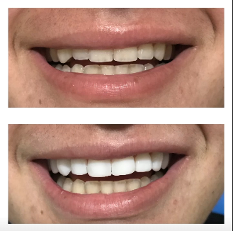 Caso de facetas em resina