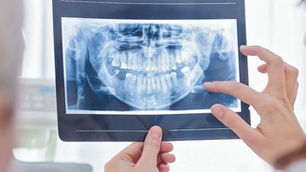 Quais prejuízos a falta de dentes pode causar para a saúde?