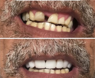 Transformação de sorriso