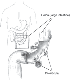 diverticula.gif