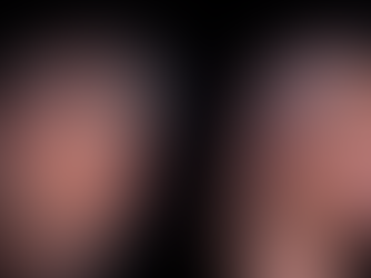 Lifting facial sem cirurgia