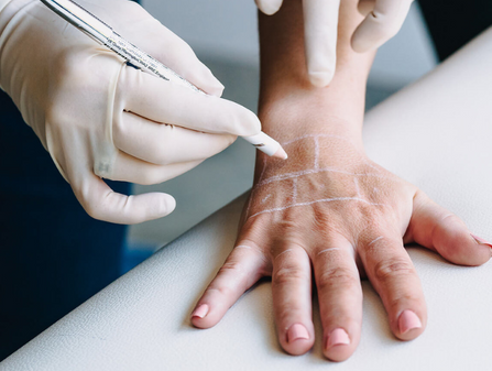 RESTYLANE LYFT PARA AS MÃOS