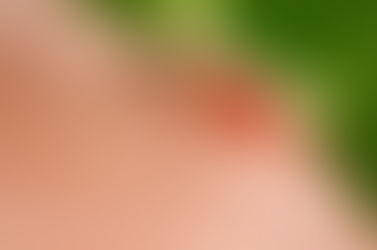 How to protect yourself when traveling in malaria-infested places