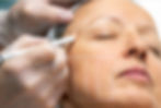 Médico marcando líneas faciales en el rostro de una mujer antes del tratamiento. Armonización facial completa (Mujer)