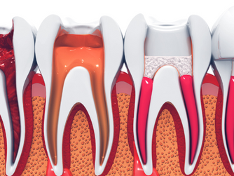 What Is Root Canal Treatment? Demystifying the Process