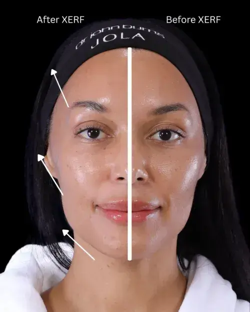 XERF Before and after image