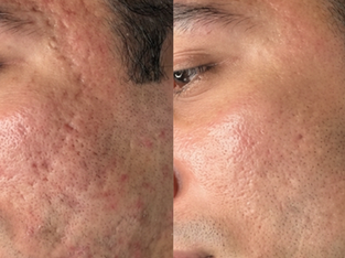 Turn Back the Clock: CO2 Laser Skin Resurfacing in Chelsea