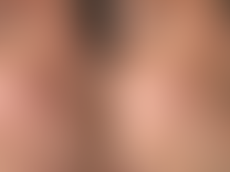 Turn Back the Clock: CO2 Laser Skin Resurfacing in Chelsea