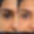 Polynucleotide treatment_Undereyes_DRV