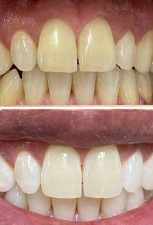 Blanqueamiento RB dental
