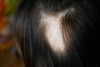 hair loss.jpeg