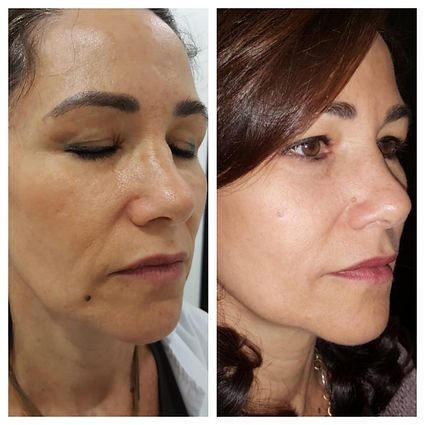 hilos tensores antes despues lateral