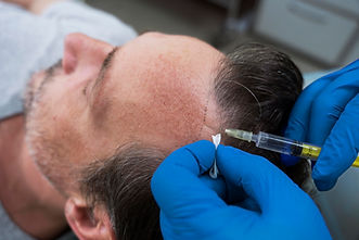 man-getting-hair-loss-treatment.jpg