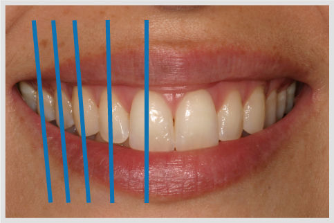Tooth-axis-or-midpoint.jpg
