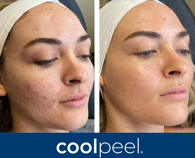 coolpeel-acne-BA-1024x1024.png