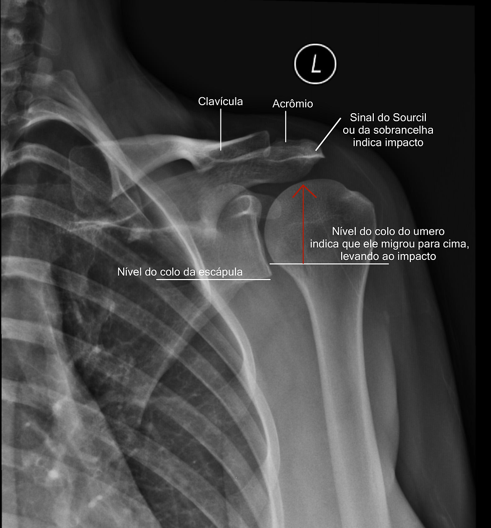 RAIO X APRESENTA MIGRAÇÃO PROXIMAL DO UMERO EVIDENTE PELA FORMAÇÃO DO DEGRAU ENTRE OS COLOS DA GLENOIDE DA ESCAPULA E DO COLO DO UMERO E COMO CONSEQUÊNCIA APRESENTA O SINAL DO SOURCIL INDICATIVO DE SÍNDROME DO IMPACTO SUBACROMIAL DO OMBRO