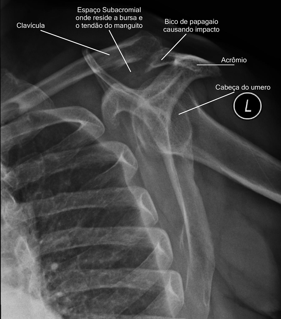 RAIO X APRESENTA BICO DE PAPAGAIO OU ACROMIO TIPO GANCHOSO CANSAUDO SINDROME DO IMPACTO SUBACROMIAL DO OMBRO