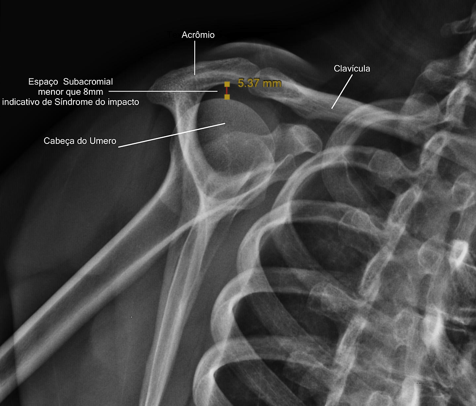 RADIOLOGIA DEMONSTRA DIMINUIÇÃO DO ESPAÇO SUBACROMIAL IGUAL A 5,37 SENDO CONSIDERADO NORMAL 8MM PORTANTO INDICATIVO DE SÍNDROME DO IMPACTO SUBACROMIAL DO OMBRO