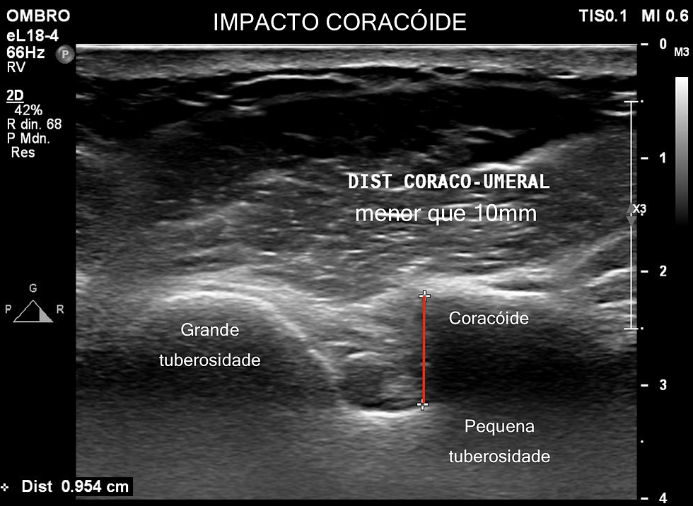 ULTRASSOM APRESENTA MEDIDA DA PONTA DA CORACÓIDE A PEQUENA TUBEROSIDADE DO UMERO DISTˆÂNCIA NORMAL MAIOR QUE 10MM NESTE CASO SE ENCONTRAVA MENOR QUE 10MM SENDO PORTANTO INDICATIVO DE SÍNDROME DO IMPACTO CORACÓIDE