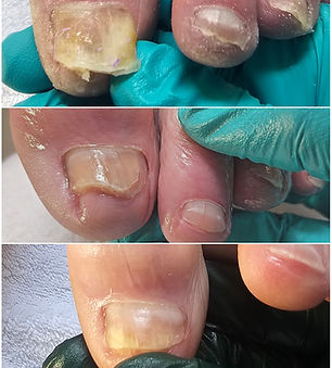 Heal by Sole Toenail Restoration