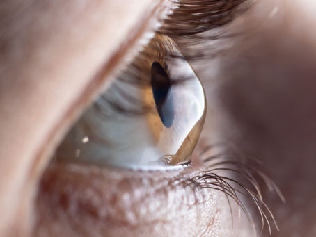 Como interromper o progresso do ceratocone?