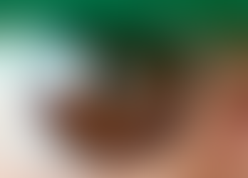 O que pode piorar a catarata?